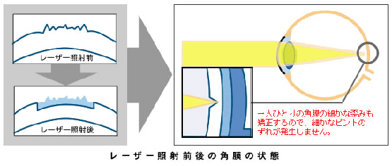 レーザー照射前後の角膜の状態